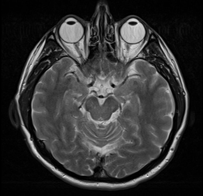 MRI não bình thường dùng huấn luyện mô hình AI